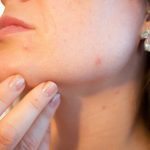 Pelle seborroica: le conseguenze dermatologiche